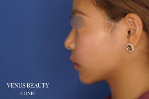 糸リフト+脂肪吸引 施術後