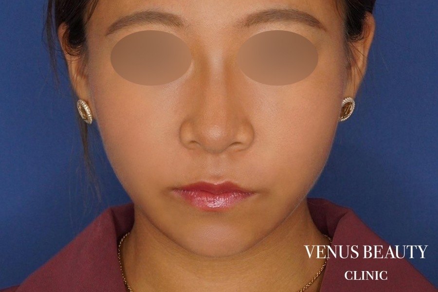 糸リフト＋脂肪吸引 施術後