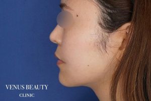 糸リフト+脂肪吸引 施術後