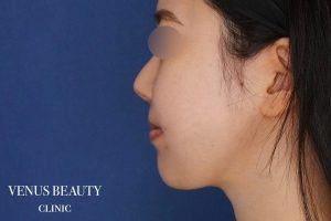 糸リフト+脂肪吸引 施術後