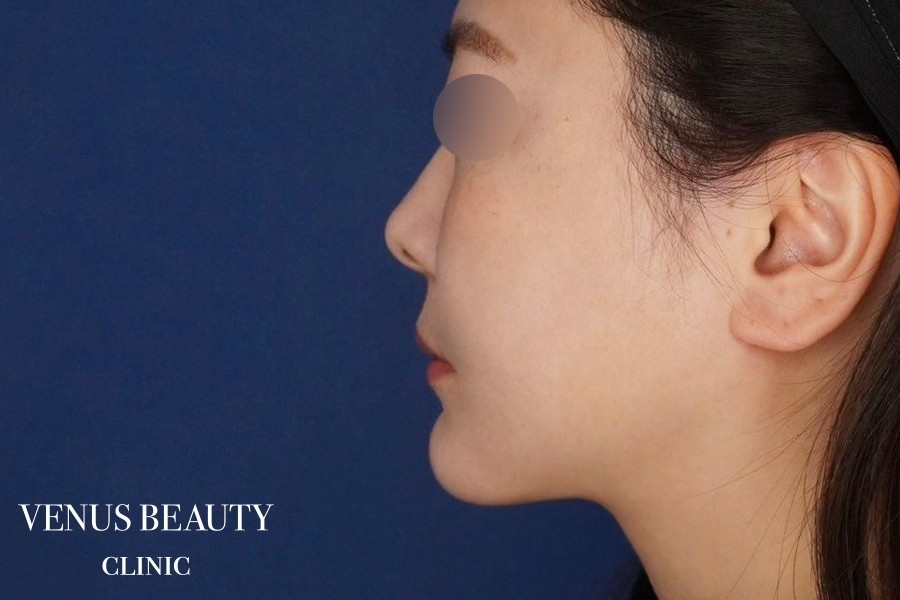 糸リフト＋脂肪吸引 施術後