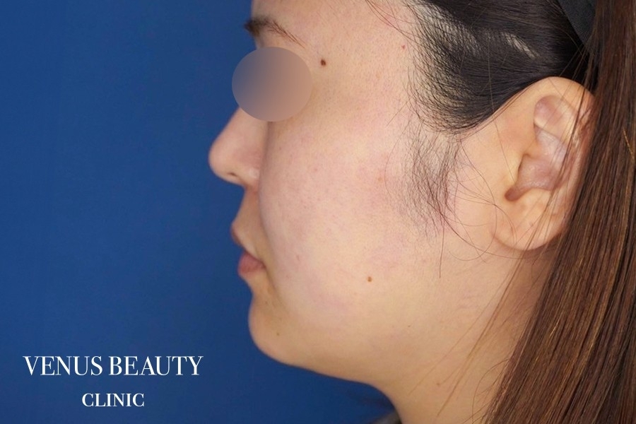 糸リフト＋脂肪吸引 施術前