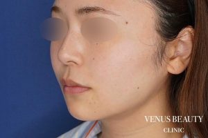 糸リフト+脂肪吸引 施術後