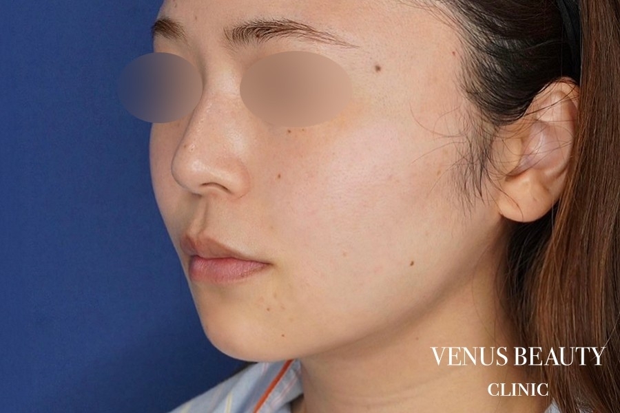 糸リフト＋脂肪吸引 施術後