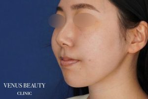 糸リフト+脂肪吸引 施術後