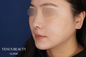 糸リフト+脂肪吸引 施術後