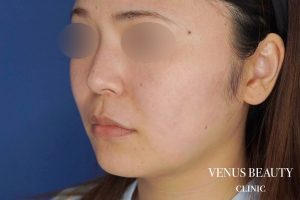 糸リフト+脂肪吸引 施術前