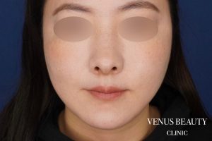 糸リフト+脂肪吸引 施術後