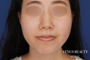 糸リフト+脂肪吸引 施術後