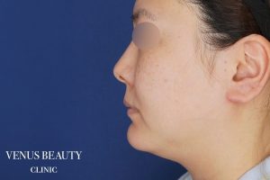 糸リフト+脂肪吸引 施術前