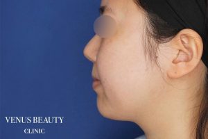 糸リフト+脂肪吸引 施術前