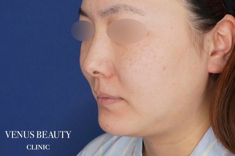 糸リフト＋脂肪吸引 施術前