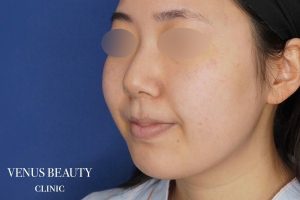 糸リフト+脂肪吸引 施術前