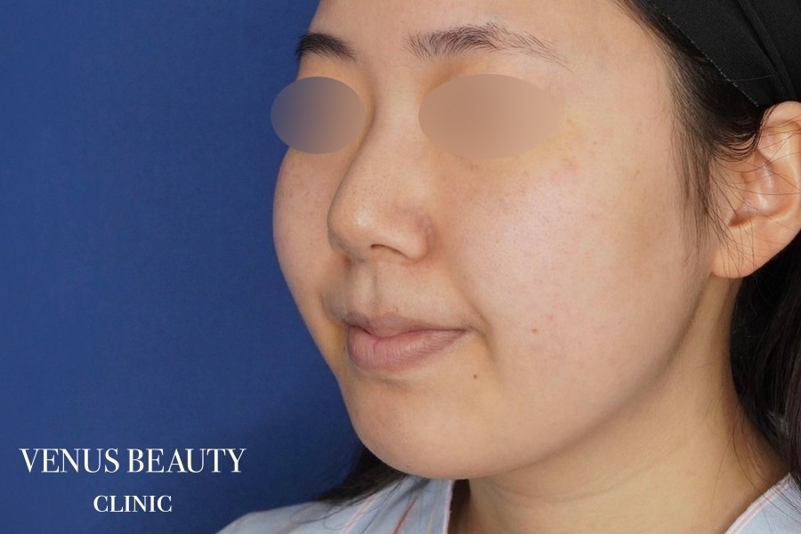 糸リフト＋脂肪吸引 施術前