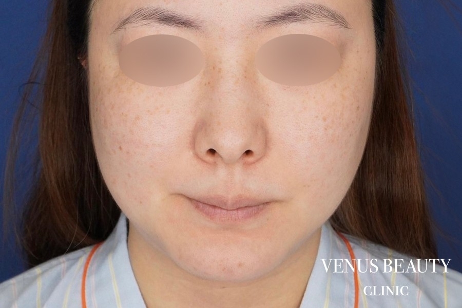 糸リフト＋脂肪吸引 施術前