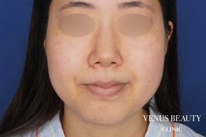 糸リフト+脂肪吸引 施術前