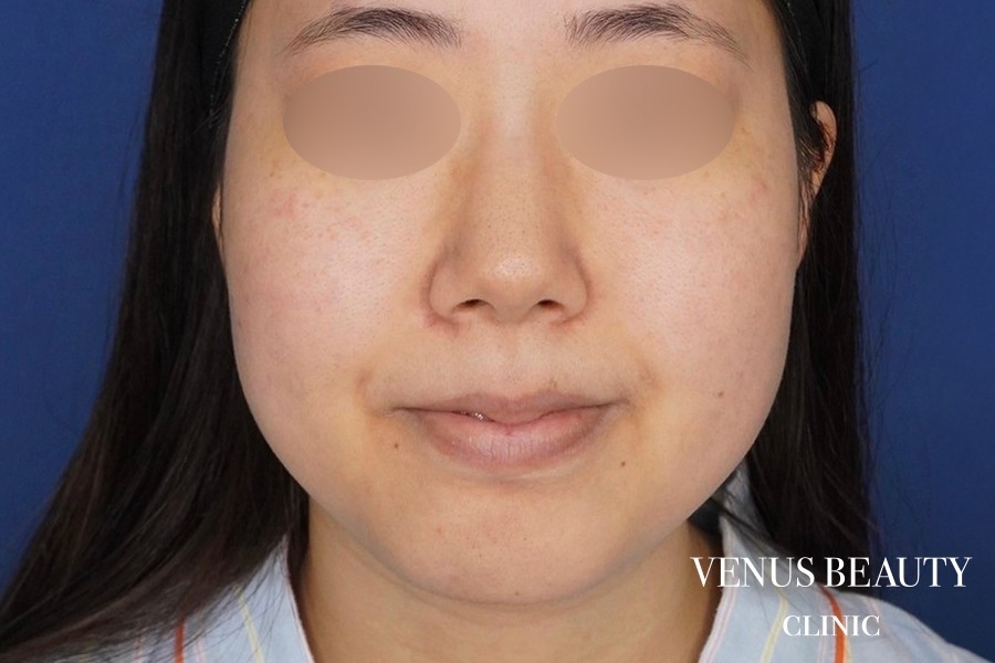 糸リフト＋脂肪吸引 施術前