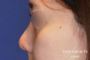 隆鼻術（シリコンプロテーゼ・筋膜移植） 施術前