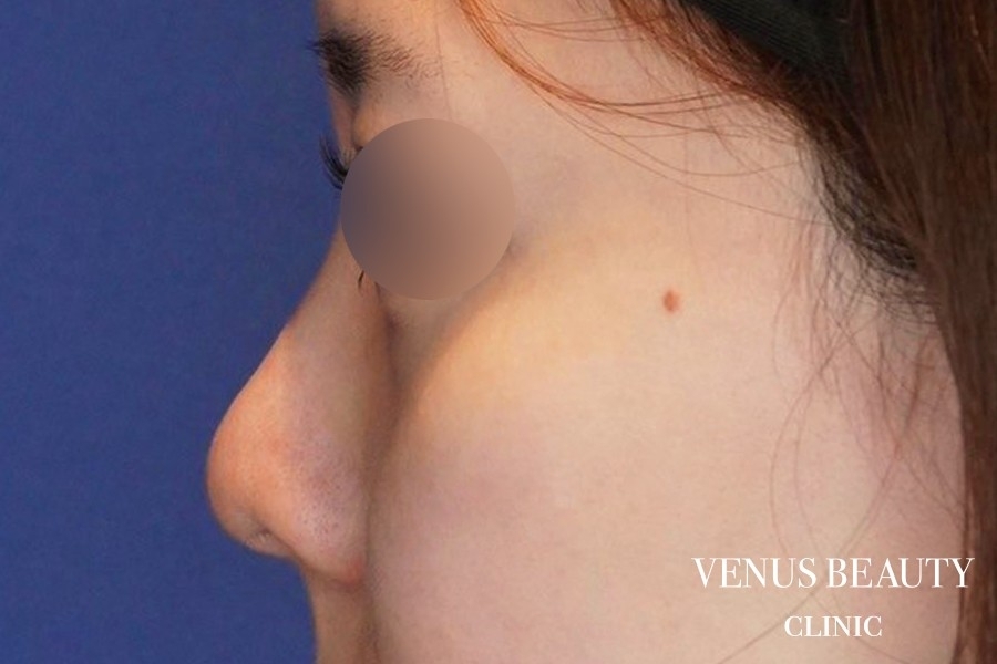 隆鼻術（シリコンプロテーゼ・筋膜移植） 施術前