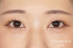 目頭切開 施術後