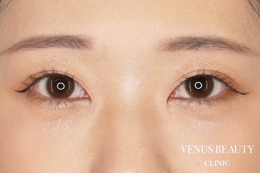 二重まぶた全切開法 施術後