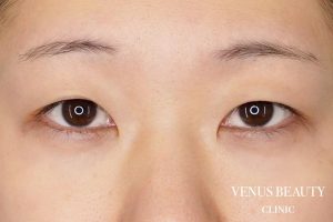 目頭切開 施術前