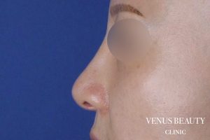 わし鼻・段鼻修正 ハンプ切除 施術後