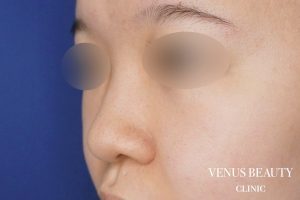 鼻中隔延長 施術前