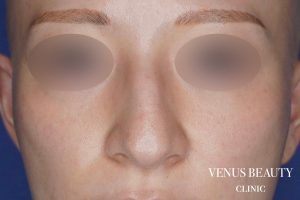 鼻翼縮小 施術前