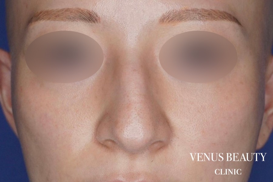 鼻翼縮小 施術前