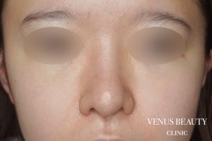 鼻翼縮小 施術後