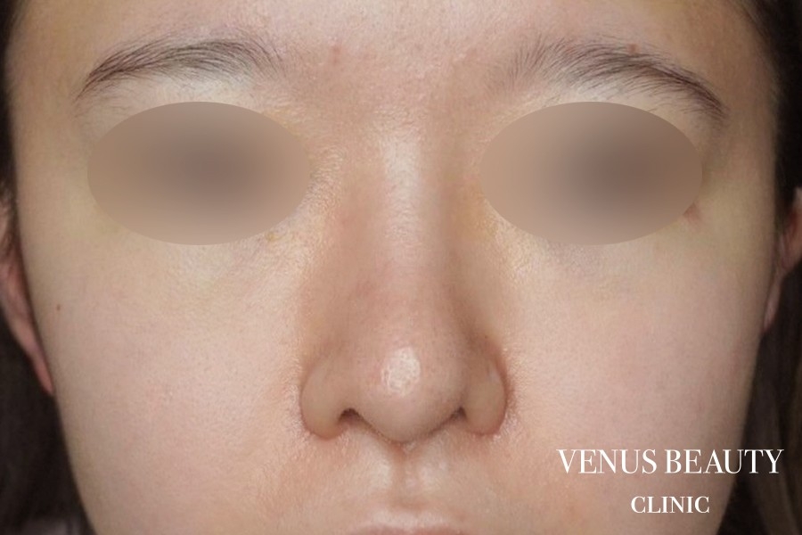 鼻翼縮小 施術後