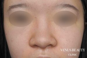 鼻翼縮小 施術前