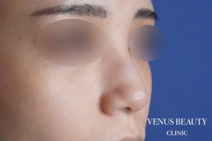 骨切幅寄せ 施術前