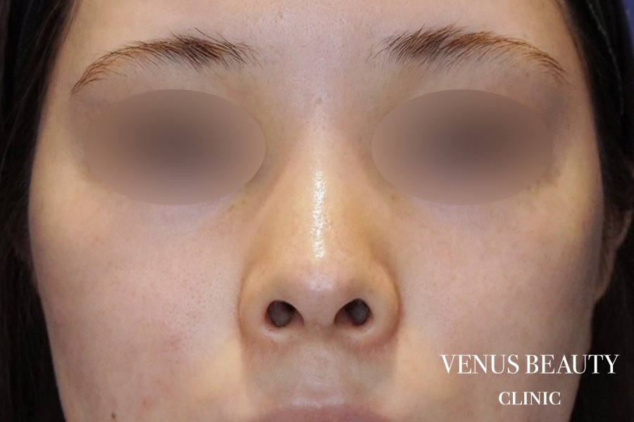鼻翼縮小 施術前