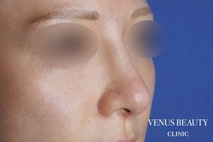 わし鼻・段鼻修正 ハンプ切除 施術後