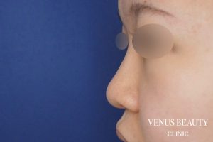 鼻中隔延長 施術前