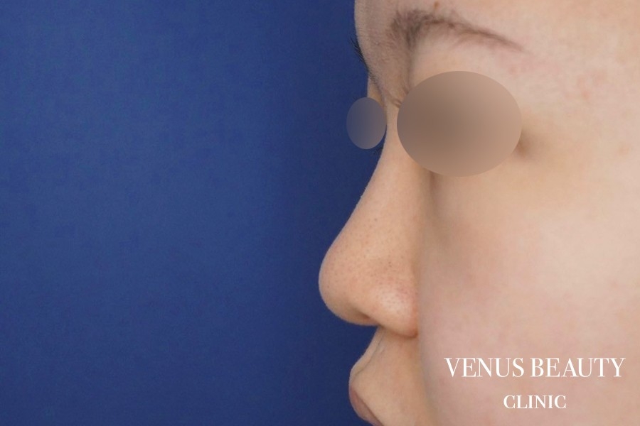 鼻中隔延長 施術前