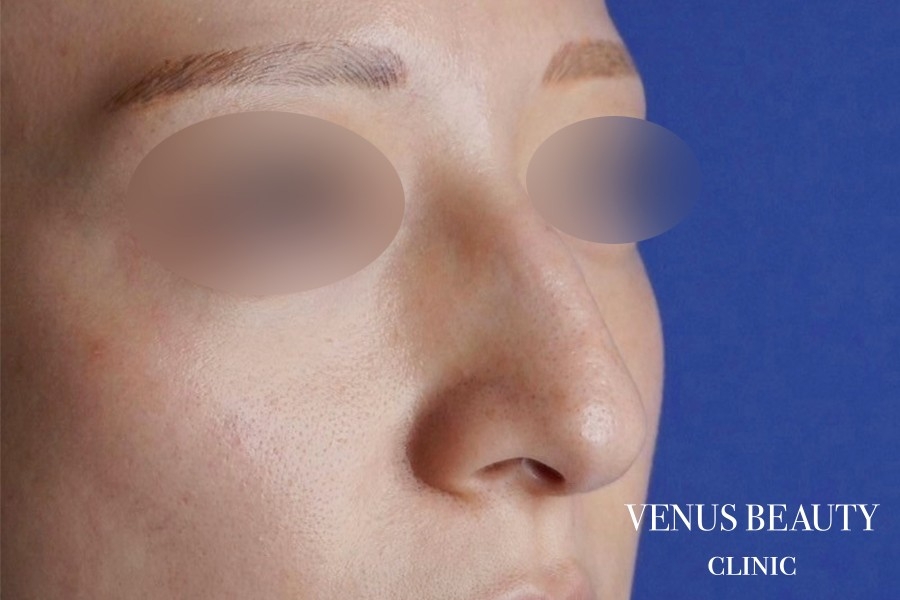 わし鼻・段鼻修正 ハンプ切除 施術前