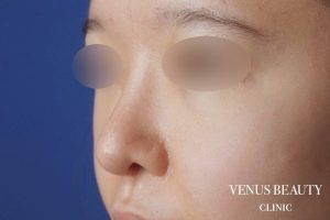 鼻中隔延長 施術後