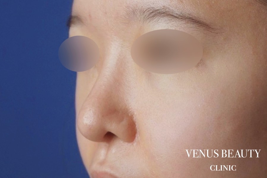 鼻中隔延長 施術後