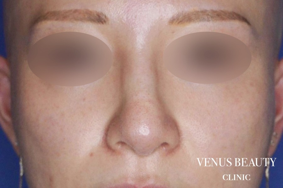 鼻翼縮小 施術後