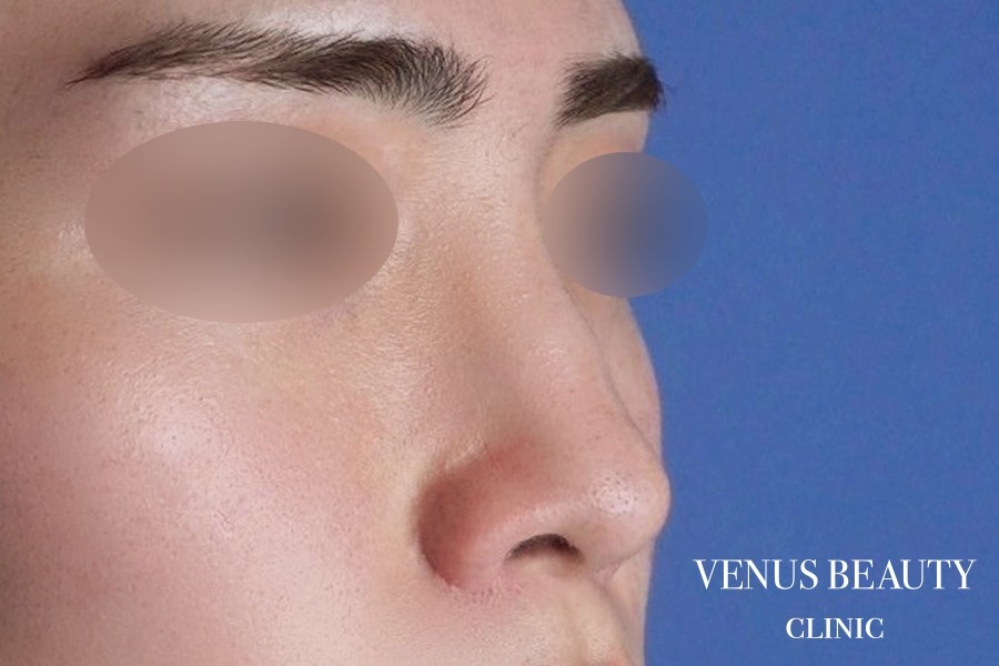 鼻尖形成 施術後