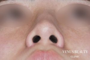 鼻翼縮小 施術後