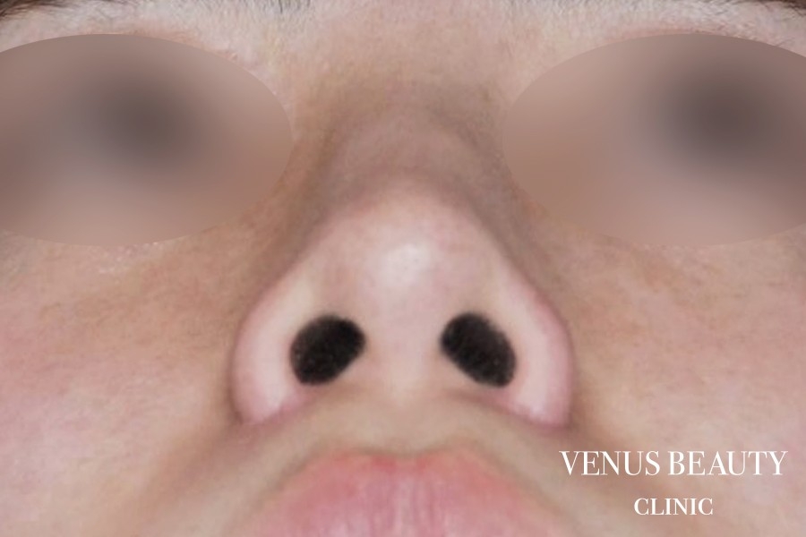 鼻翼縮小 施術後