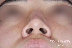 鼻翼縮小 施術前