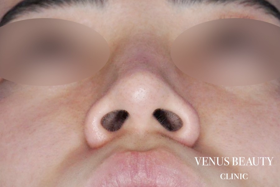 鼻翼縮小 施術前