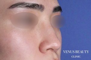 鼻尖形成 施術前
