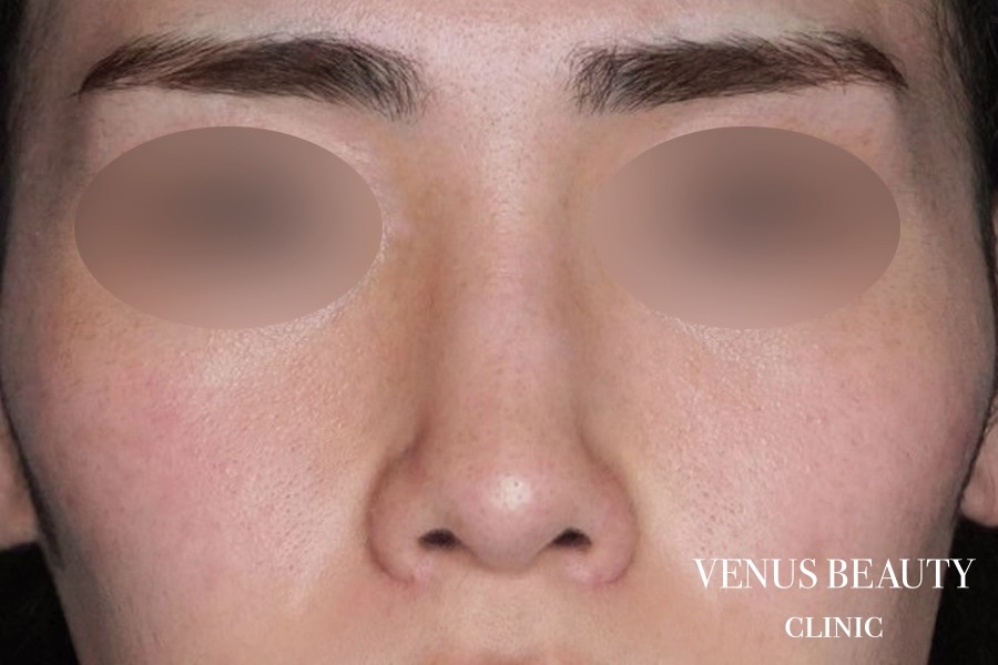 鼻尖形成 施術後