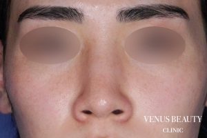 鼻翼縮小 施術前